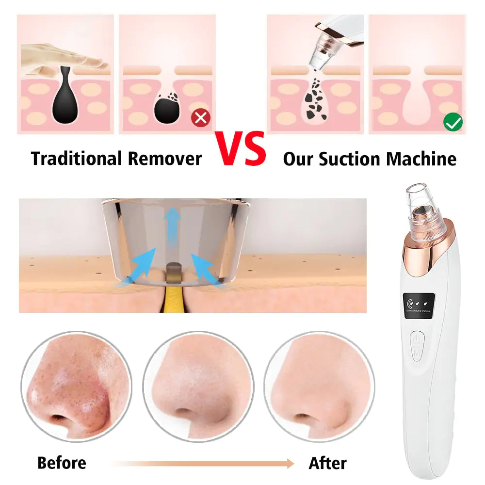 RadiantSkin Pro: Beauty Electric Blackhead Remover